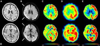 Magnetic resonance imaging arterial spin labeling hypoperfusion with diffusion-weighted image hyperintensity is useful for diagnostic imaging of Creutzfeldt–Jakob disease